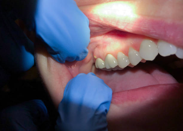 Best Emergency Wisdom Teeth Removal in Hartford, AL