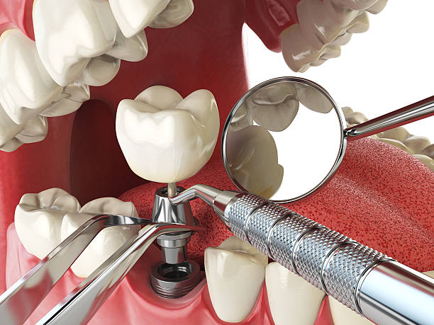 Best Emergency Treatment for Dental Infections or Abscesses in Hartford, AL